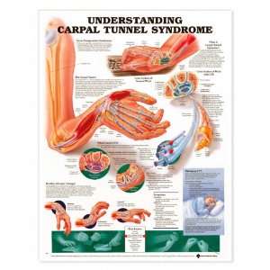 Understanding Carpal Tunnel Syndrome Anatomical Chart Paper Unmounted 