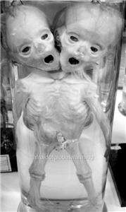 Old Photo Paris Fetus   Siamese Twins  
